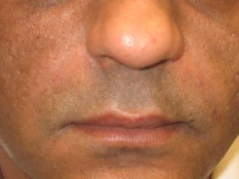 Radiesse Injections after 272053