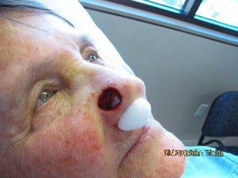 Before reconstruction, but after Mohs surgery before 480735