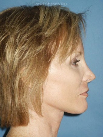 Facelift, Endoscopic Browlift, Upper and Lower Blepharoplasty, Perioral Dermabrasion after 248859