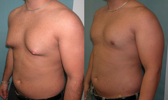 Gynecomastia Surgery after 340651