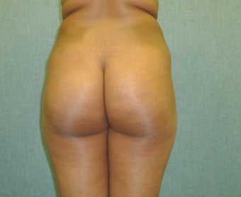 Brazilian Butt Lift 392905