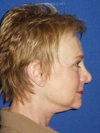 Facelift, Anterior Hairline Browlift, Upper and Lower Blepharoplasty with Canthopexy, Lip augmentation with Alloderm Grafts after 248892