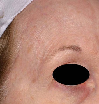 Blue veins around eyes after 135044