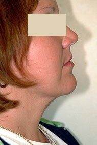 Neck Liposuction after 87335