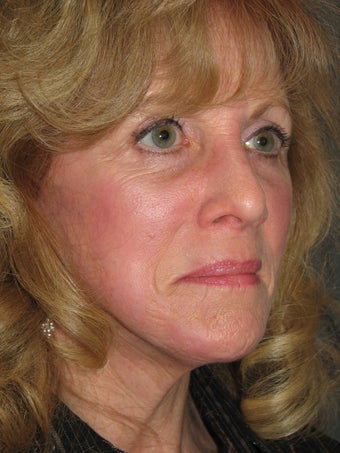 Facelift and Chemical Peel after 123605