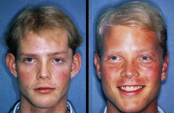 Ear Reshaping (Otoplasty) before 599388