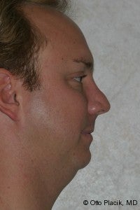 Chin Augmentation before 565878