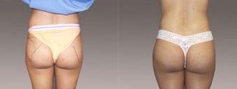 Fat Transfer/Buttock Reshaping before 395837