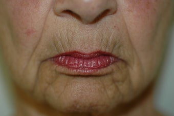 Hetter facial resurfacing before 434879