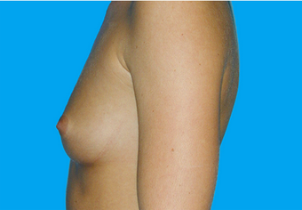 Breast Augmentation 335916