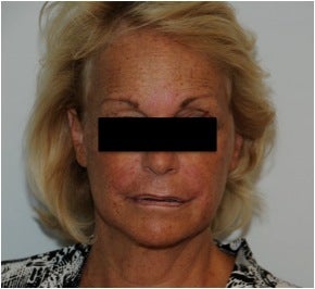 Evolence Injection in Glabella to Reduce Static Wrinkles after 123624
