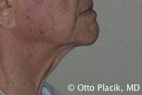 Cervicoplasty before 567304