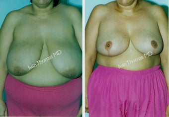 Breast Reduction before 243750