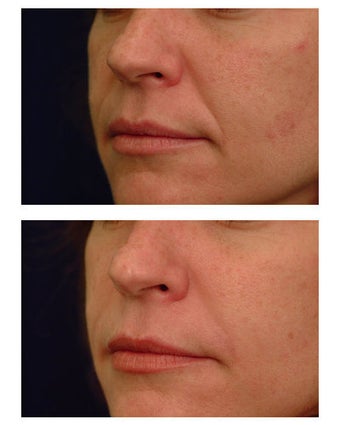 Juvederm before 301138