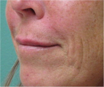 Juvederm to Upper Lip after 77462