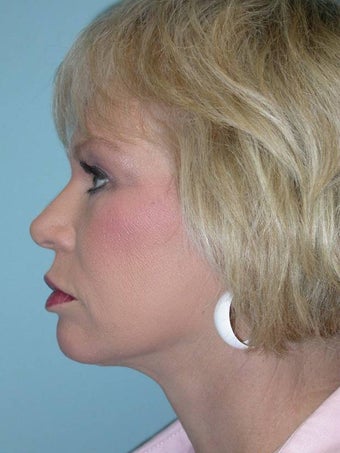Full Facial Rejuvenation after 148575