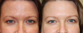 Non-Surgical Facial Rejuvenation with BOTOX Cosmetic and Silikon-1000 before 128807