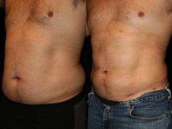 Liposuction before 420935