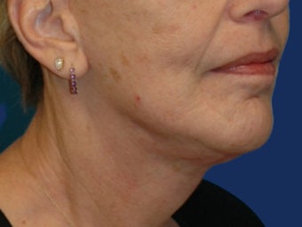 Lower Facelift and Necklift with Platysmaplasty after 243449