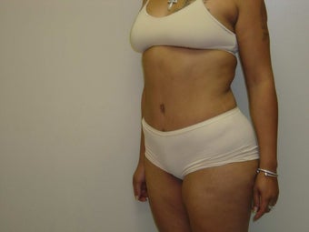 Tummy Tuck after 504651