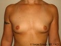 Breast Augmentation before 147547