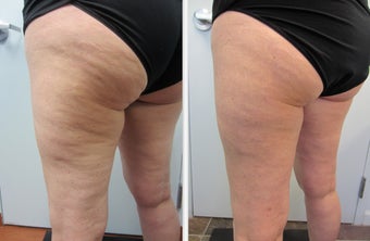 Cellulaze Laser Cellulite Reduction before 596652