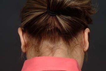 Otoplasty after 292476