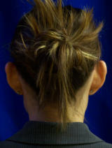 Ear Surgery (otoplasty) before 130067