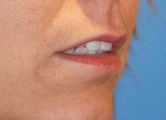 Lip Augmentation before 199329