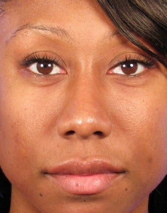 Rhinoplasty after 400980