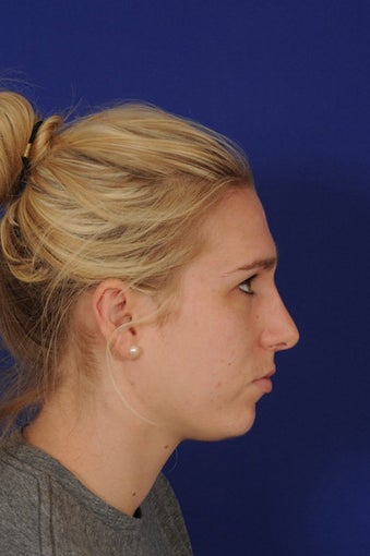 rhinoplasty after 274533