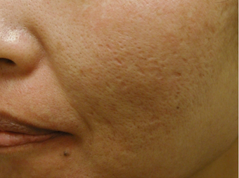 Acne Scars 200602