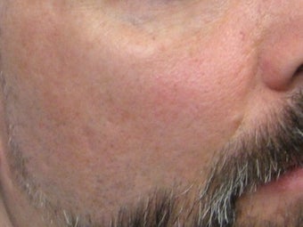 CO2 Fractionated Laser Resurfacing after 272016