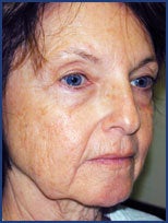 CO2 laser skin resurfacing before 87080