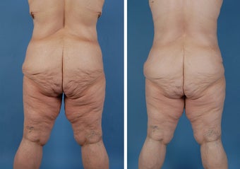 Upper Body Lift 303697
