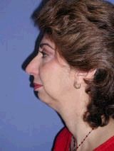 Chin Implants before 357646