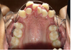 Braces and Extraction before 349028