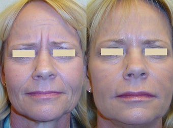 Botox and Fillers before 92984