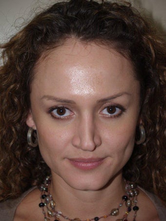 Revision Rhinoplasty before 330464