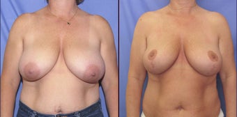 Breast Reduction before 98605