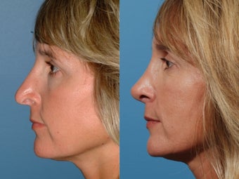 Revision rhinoplasty 355710
