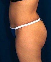 Brazilian Butt Lift 635100