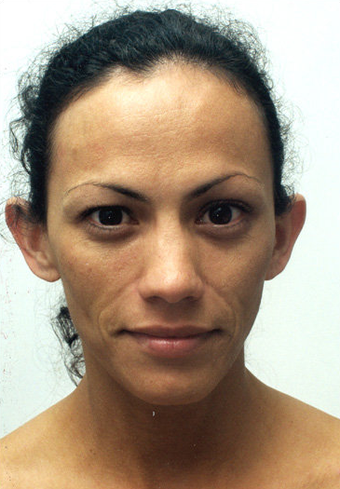 endoscopic brow-lift, upper and lower lid blepharoplasty, septorhinoplasty and lipo transfer to the midface area before 301281