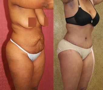 tummy tuck after 304701