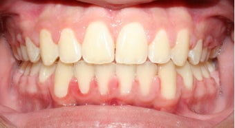 Teen Orthodontic Treatment (case #1DC) after 224713