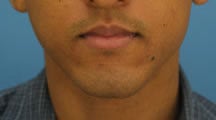 Lip Surgery, Lip Reduction before 459004