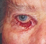 Eyelid skin cancer reconstruction before 84505