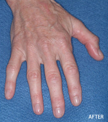Radiesse Filler Augmentation of the Hands after 328103