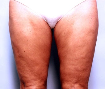 Slim Lipo after 137501