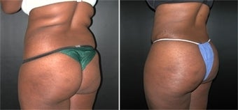 Buttock Augmentation before 110112